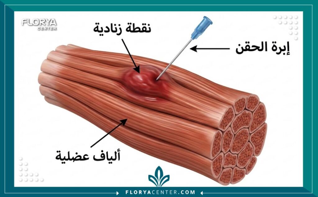 رسم توضيحي طبي يشرح تشريح النقطة الزنادية داخل العضلة وكيفية استهدافها بالإبرة.