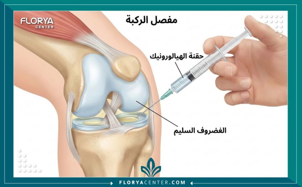 رسم تخطيطي طبي يوضح موقع حقن إبر الزيت داخل مفصل الركبة.