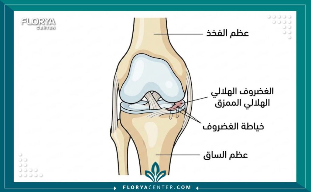 رسم توضيحي طبي تشريحي للركبة يظهر عملية خياطة الغضروف الهلالي الممزق مع تسميات باللغة العربية
