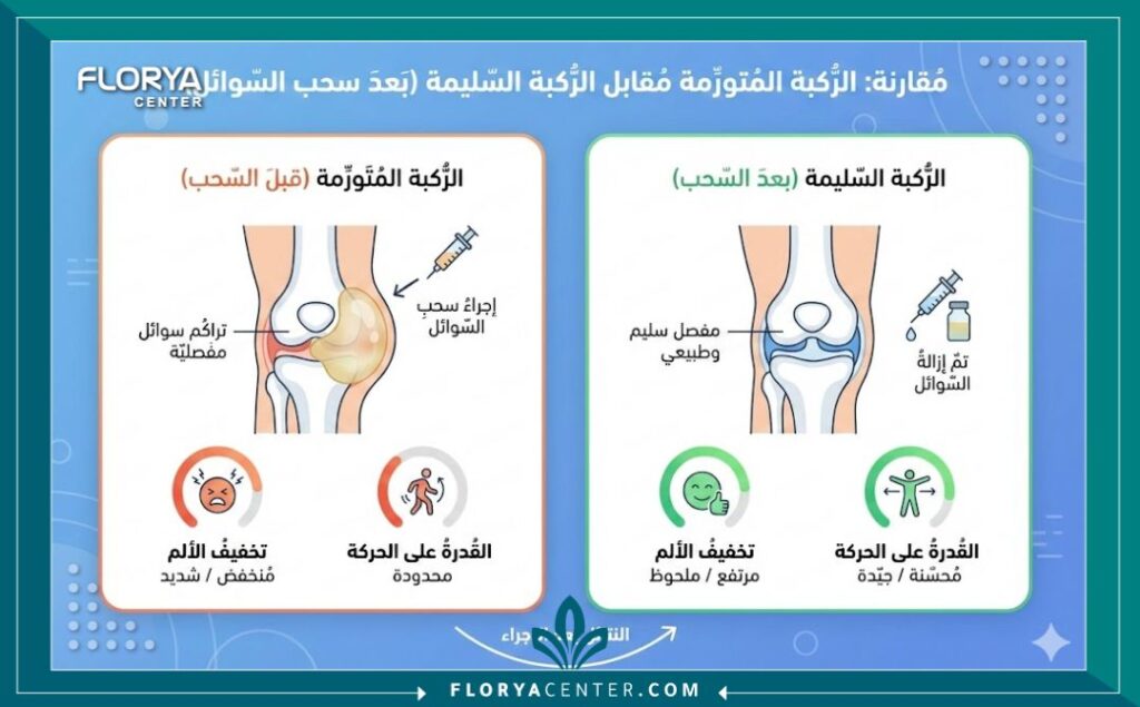 إنفوجرافيك يوضح سحب السوائل من الركبة في تركيا و الفرق بين الركبة قبل وبعد سحب السوائل وفوائد العملية في تحسين الحركة.
