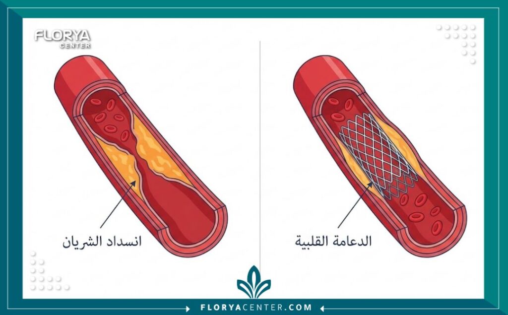 رسم توضيحي طبي يشرح كيفية فتح الشريان المسدود باستخدام الدعامة والقسطرة.