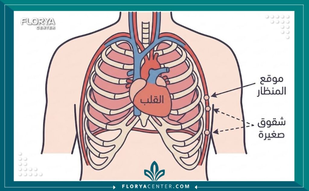 رسم تخطيطي طبي يوضح كيفية إجراء عملية القلب بالمنظار من خلال شقوق صغيرة.