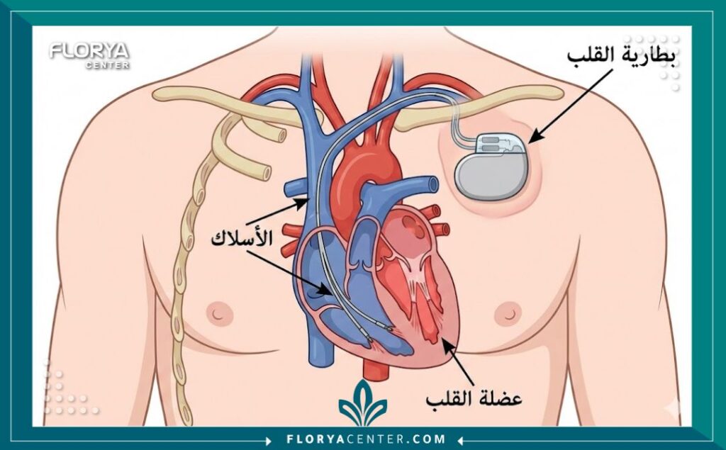 رسم تخطيطي طبي يوضح مكان زرع بطارية القلب وتوصيل الأسلاك بالقلب