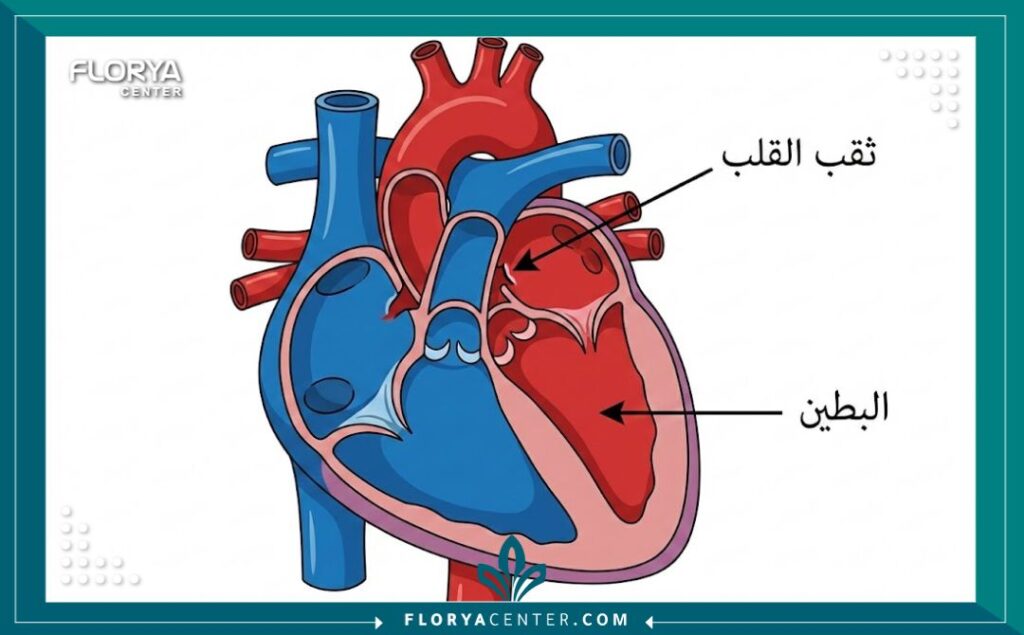 رسم تخطيطي طبي يوضح أماكن ثقب القلب عند الأطفال (الحاجز البطيني والأذيني).