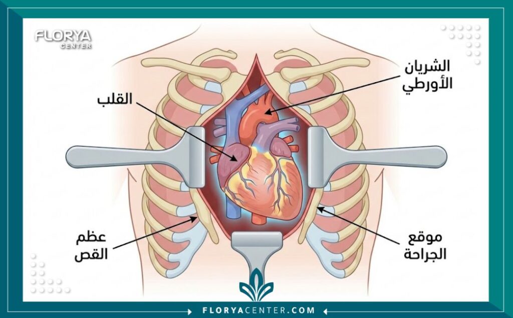 رسم توضيحي طبي يظهر تشريح الصدر والقلب أثناء إجراء عملية القلب المفتوح مع تسميات توضيحية باللغة العربية.