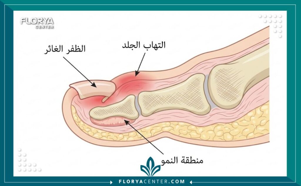 رسم توضيحي طبي يشرح تشريح الظفر الغائر وكيفية تغلغل حافة الظفر داخل الجلد.