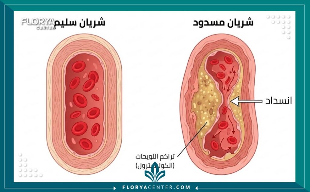 رسم توضيحي طبي يظهر مقطعاً عرضياً للفرق بين شريان سليم وشريان مسدود بسبب تراكم الدهون، يوضح أسباب انسداد الشرايين.