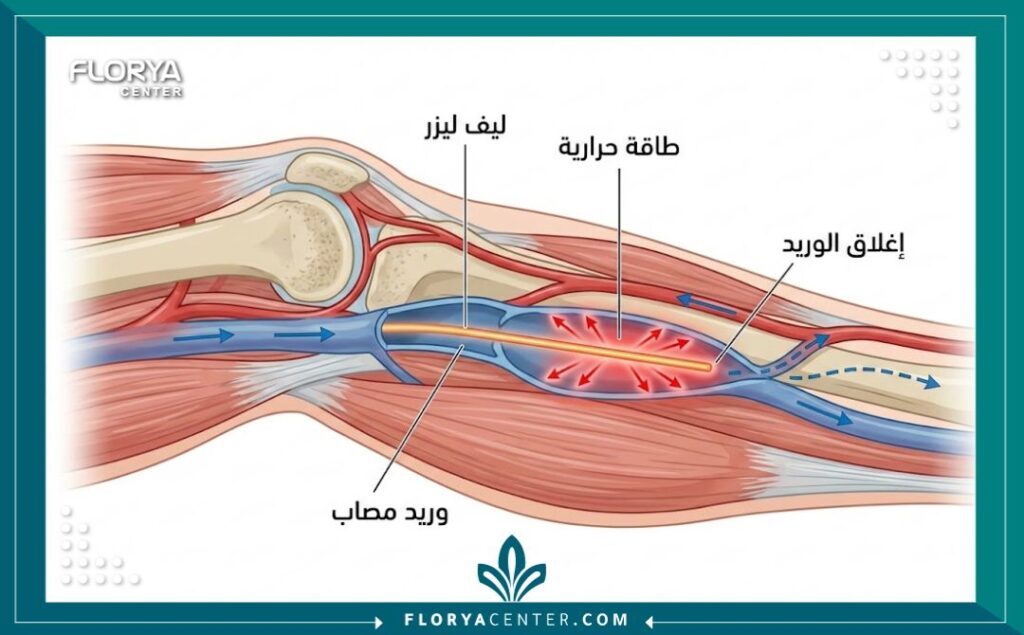 رسم توضيحي طبي يظهر كيفية عمل علاج الدوالي بالليزر داخل الوريد، مع تسميات توضيحية باللغة العربية.