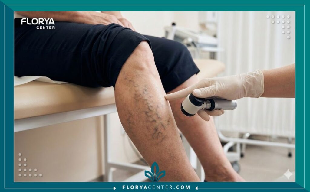 لقطة مقربة لساق مريض تظهر فيها الدوالي بوضوح أثناء فحص طبيب متخصص لتقييم الحالة قبل العلاج بالليزر.