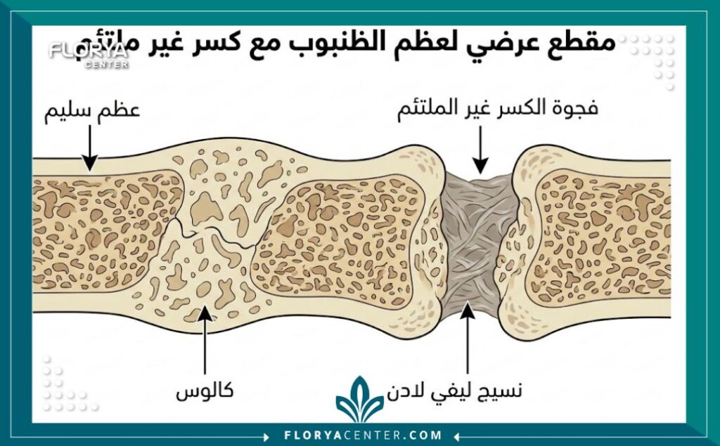 رسم توضيحي طبي يظهر مقطعاً عرضياً لعظم الساق مصاب بعدم التئام الكسر، موضحاً الفجوة والأنسجة الليفية مع تسميات باللغة العربية.
