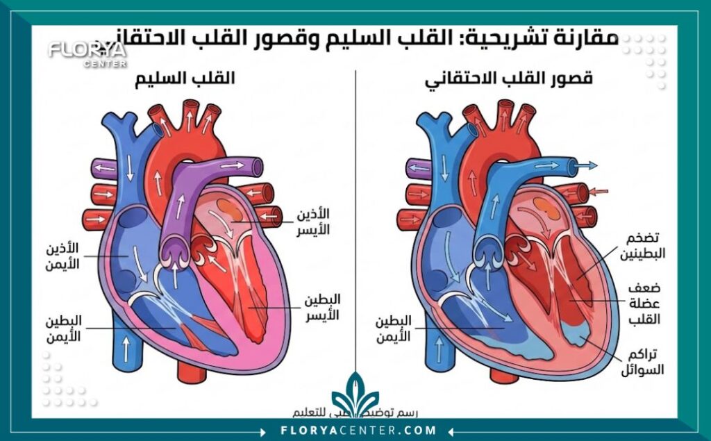 علاج قصور القلب في تركيا 2 رسم توضيحي طبي يشرح تشريح القلب وقصور القلب مع تسميات باللغة العربية.
