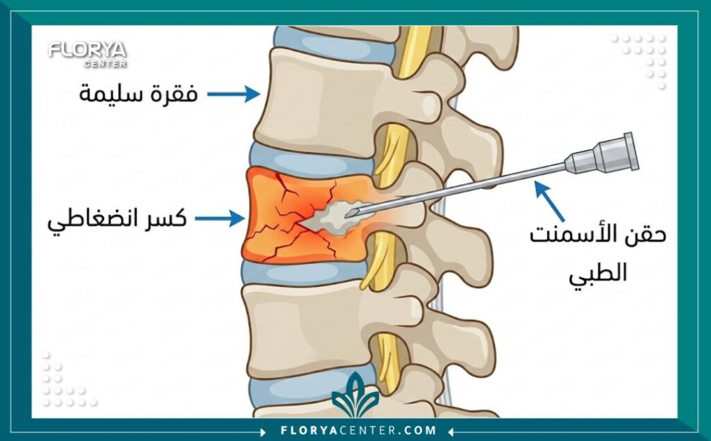 رسم توضيحي طبي يظهر تشريح العمود الفقري، ويوضح كسر الفقرات الانضغاطي وإجراء حقن الأسمنت الطبي (Vertebroplasty) كعلاج.