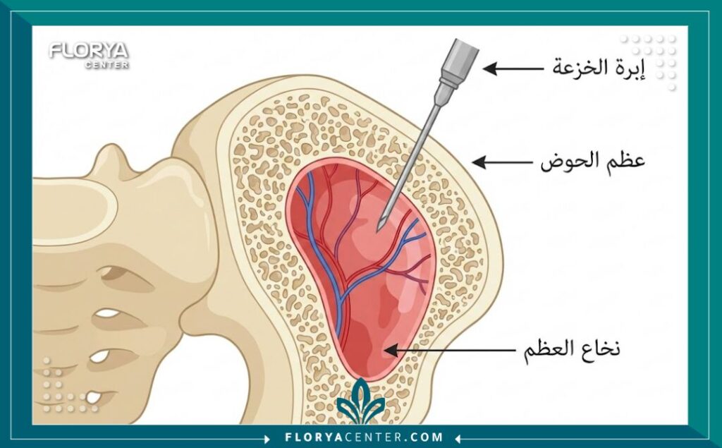 رسم توضيحي طبي يظهر مقطعاً عرضياً لعظم الحوض ويوضح كيفية دخول إبرة الخزعة لسحب عينة من نخاع العظم.