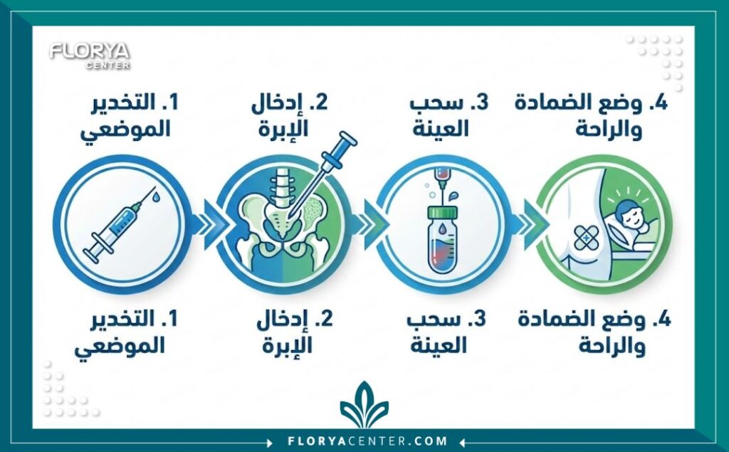  إنفوجرافيك مبسط يوضح الخطوات الأربع الرئيسية لإجراء عملية سحب خزعة نخاع العظم، بدءاً من التخدير الموضعي وحتى سحب العينة ووضع الضمادة الطبية.