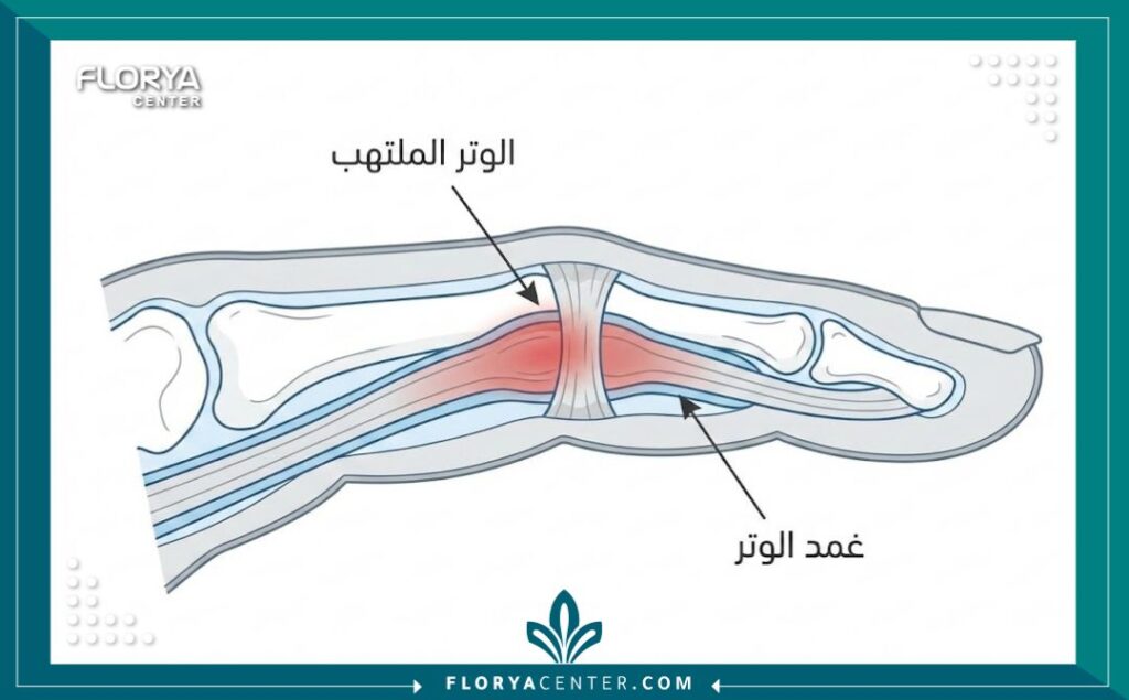 رسم توضيحي طبي يشرح تشريح إصبع الزناد والتهاب غمد الوتر الذي يتطلب الجراحة.