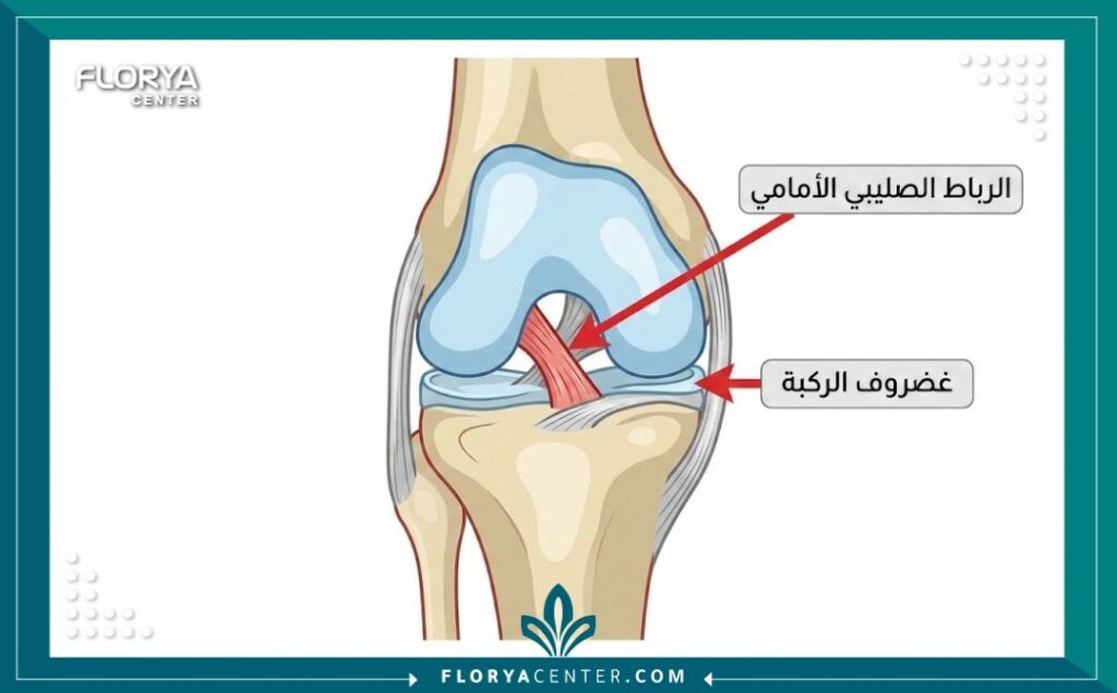 عملية إعادة بناء الرباط الصليبي في تركيا 2 رسم تخطيطي طبي يوضح تشريح الرباط الصليبي في الركبة والأجزاء المتضررة.