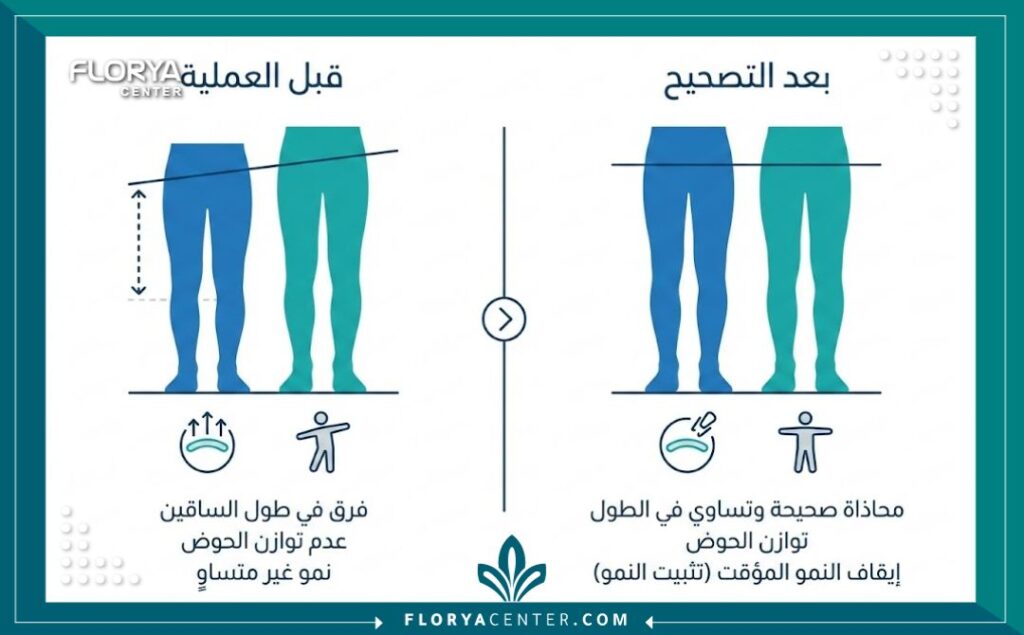 عملية إيقاف النمو المؤقت 3 إنفوجرافيك يوضح مقارنة بين طول الساقين قبل وبعد عملية إيقاف النمو المؤقت.