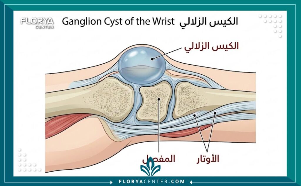 عملية استئصال الكيس الزلالي 1 - عملية استئصال الكيس الزلالي تعتبر عملية استئصال الكيس الزلالي (Ganglion Cyst Removal) من الحلول الجراحية المتقدمة التي يوفرها مركز فلوريا للتخلص النهائي من التجمعات السائلة المزعجة واستعادة كفاءة حركة المفاصل المتضررة بدقة.