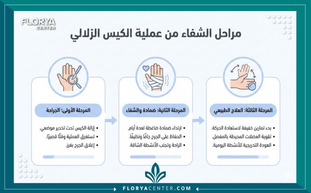 انفوجرافيك يوضح مراحل التعافي والجدول الزمني بعد عملية استئصال الكيس الزلالي.