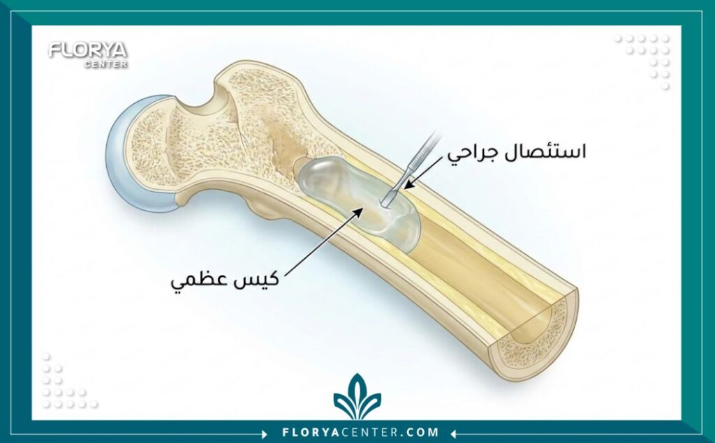 رسم توضيحي طبي يشرح تشريح الكيس العظمي وكيفية إجراء عملية الاستئصال من العظام.