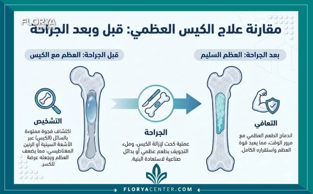 إنفوجرافيك يوضح خطوات علاج الكيس العظمي ومراحل التعافي بعد التدخل الجراحي وعملية استئصال الكيس العظمي.