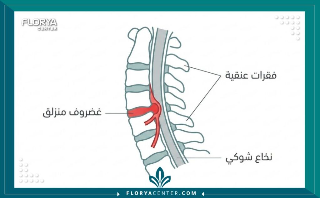 مخطط تشريحي يوضح انزلاق الغضروف العنقي والضغط على الأعصاب