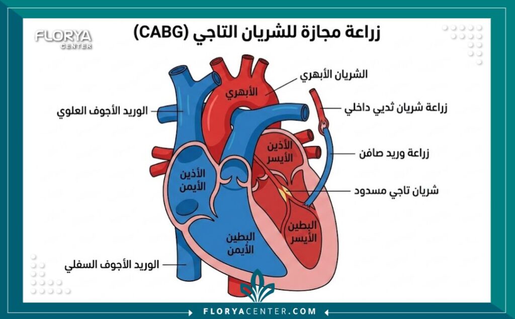 مخطط طبي توضيحي يظهر كيفية زراعة الشرايين التاجية في عملية القلب المفتوح.