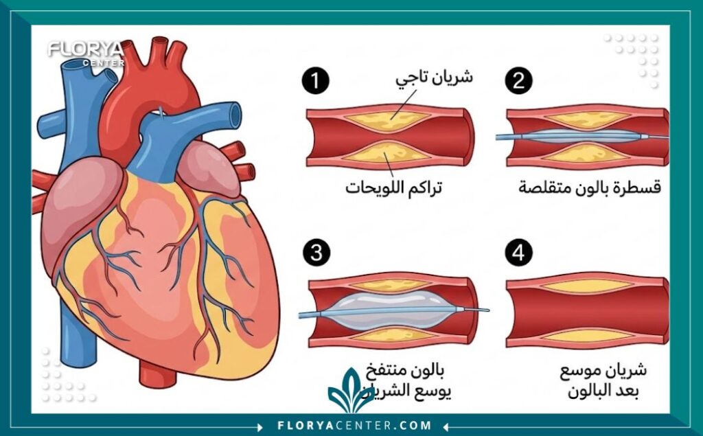 مخطط طبي يوضح مراحل عملية توسيع الشريان التاجي باستخدام بالون القلب (قسطرة الشرايين).