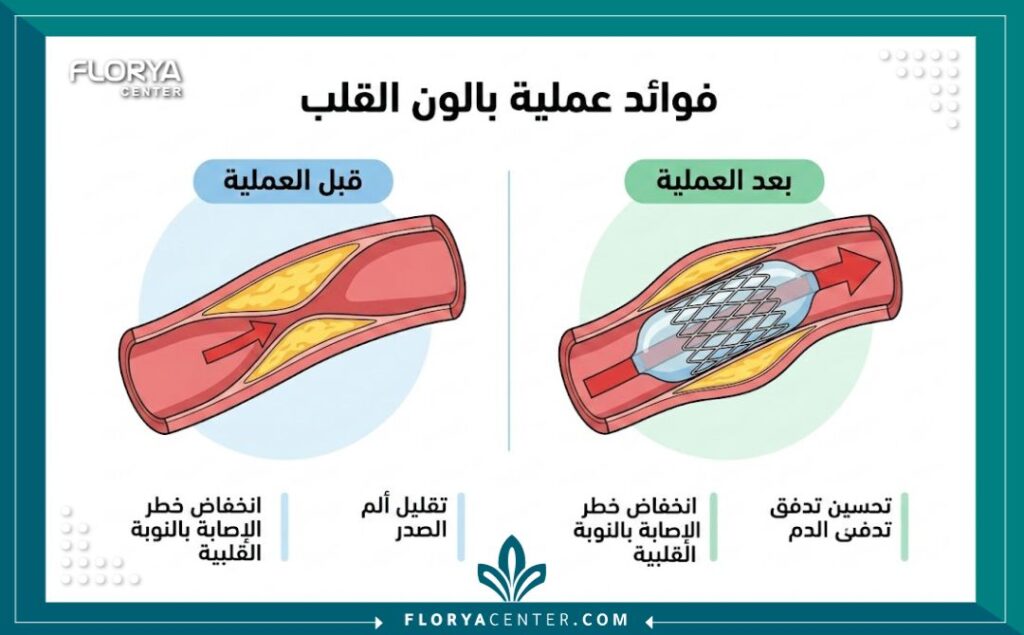 إنفوجرافيك طبي يقارن بين تدفق الدم في الشريان قبل وبعد عملية بالون القلب.