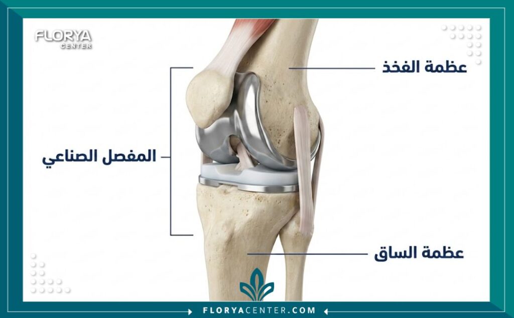 رسم توضيحي طبي يظهر مكونات مفصل الركبة الصناعي المستخدم في عملية تغيير المفصل.