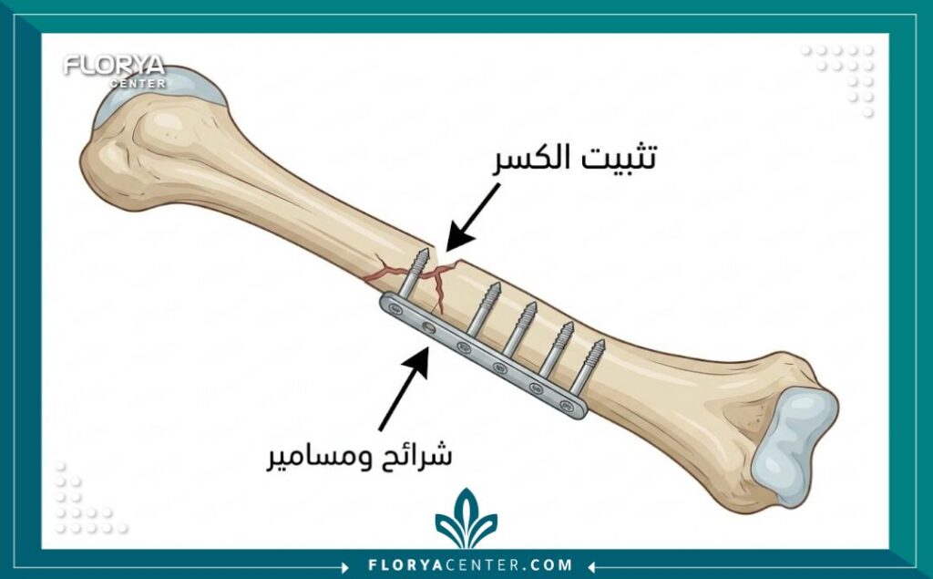 رسم توضيحي طبي يظهر كيفية تثبيت كسر العظام باستخدام شريحة معدنية ومسامير طبية.