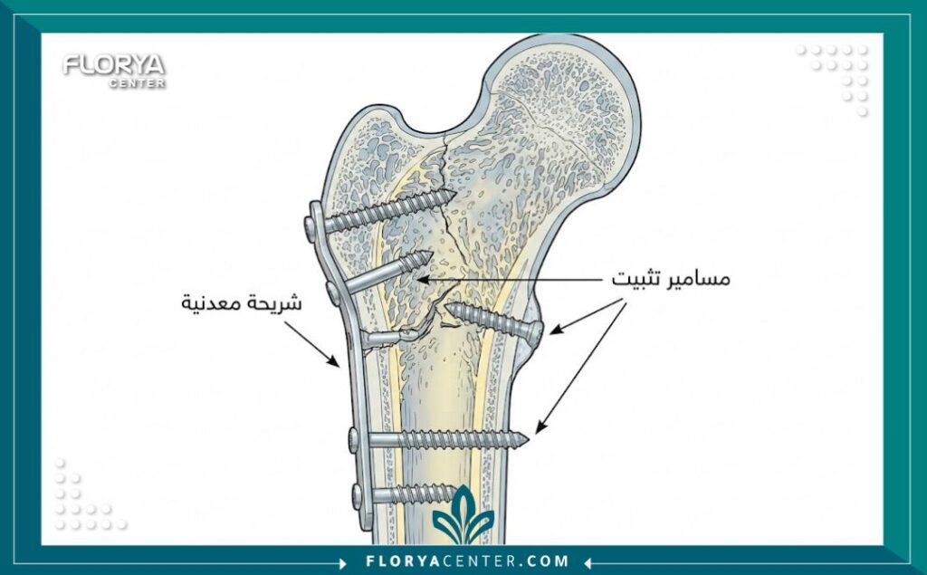رسم توضيحي طبي يظهر طريقة تثبيت الكسر باستخدام الشرائح والمسامير المعدنية.