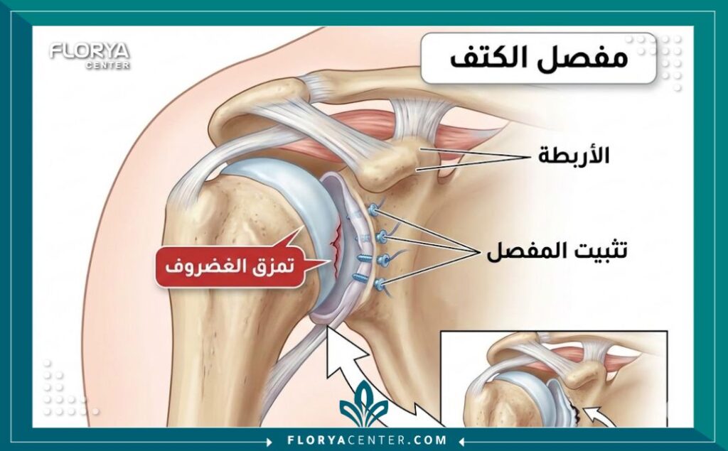 رسم توضيحي طبي يوضح تشريح مفصل الكتف وكيفية تثبيت الأربطة الممزقة.