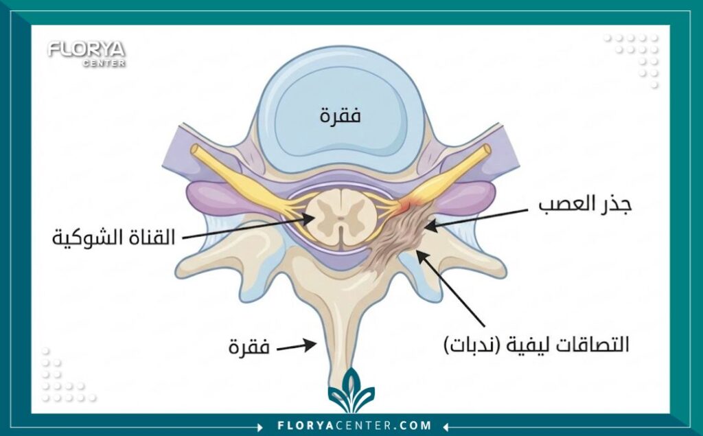 رسم توضيحي يبيّن التصاقات الجذور العصبية داخل القناة الشوكية.