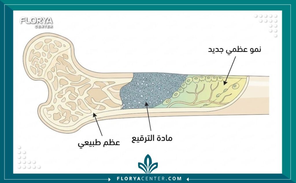 رسم توضيحي طبي يشرح مراحل التحام طعم العظام مع العظم الطبيعي للمريض.