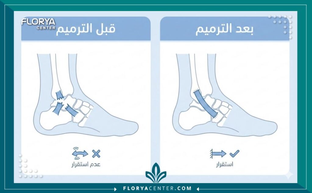 إنفوجرافيك مقارنة بين الكاحل المصاب والكاحل السليم بعد عملية ترميم أربطة الكاحل المزمنة.