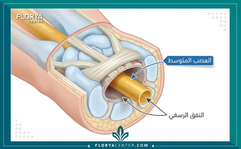 مخطط تشريحي يوضح موقع عصب اليد المضغوط وحالة النفق الرسغي.