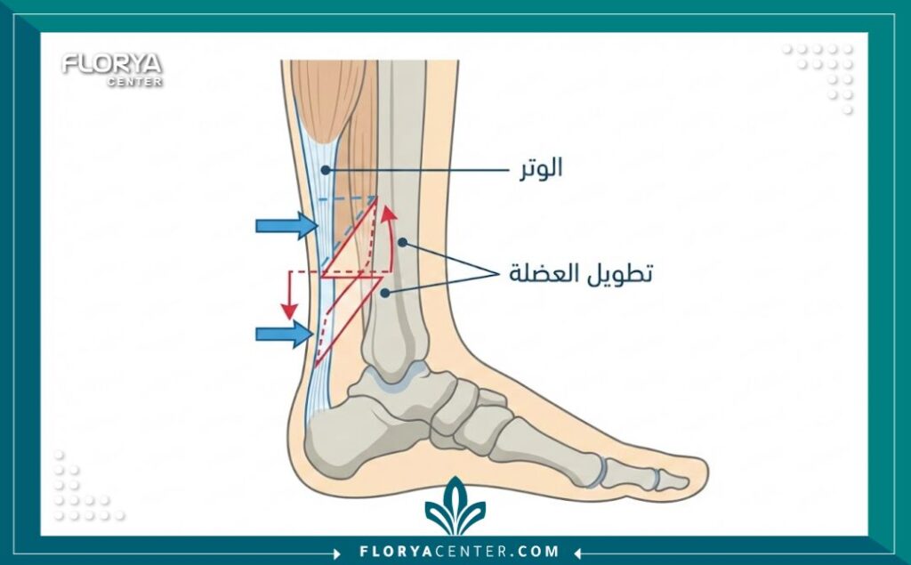 رسم تخطيطي طبي يوضح تقنية إطالة وتر العرقوب (Achilles tendon) للأطفال.