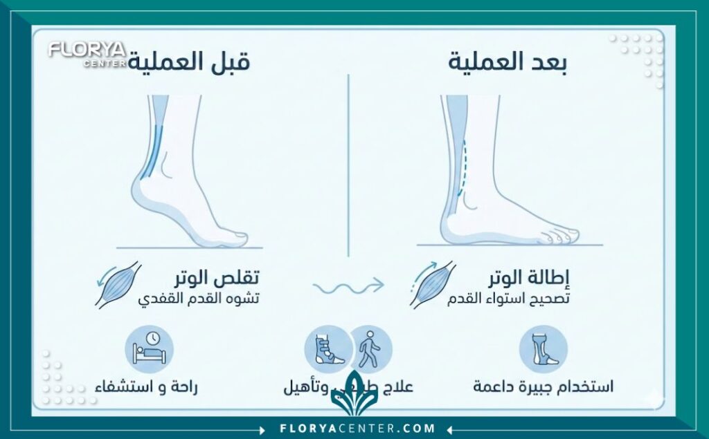 إنفوجرافيك يوضح الفرق قبل وبعد عملية تطويل الأوتار للأطفال وتصحيح مشية الأطفال.