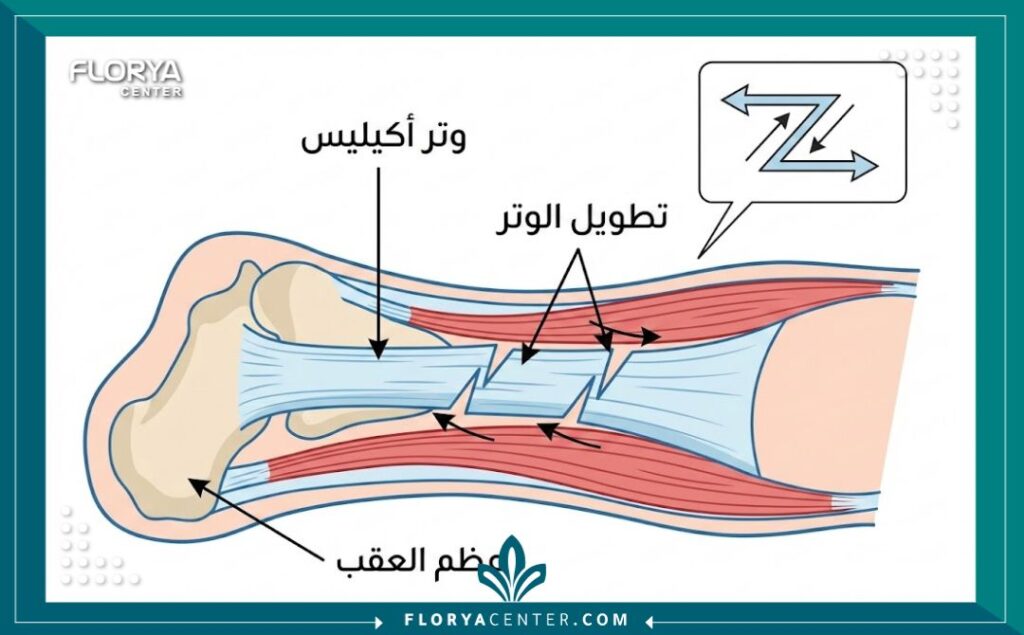 رسم توضيحي طبي يوضح تشريح وتر أكيليس وطريقة تطويل الأوتار جراحياً.
