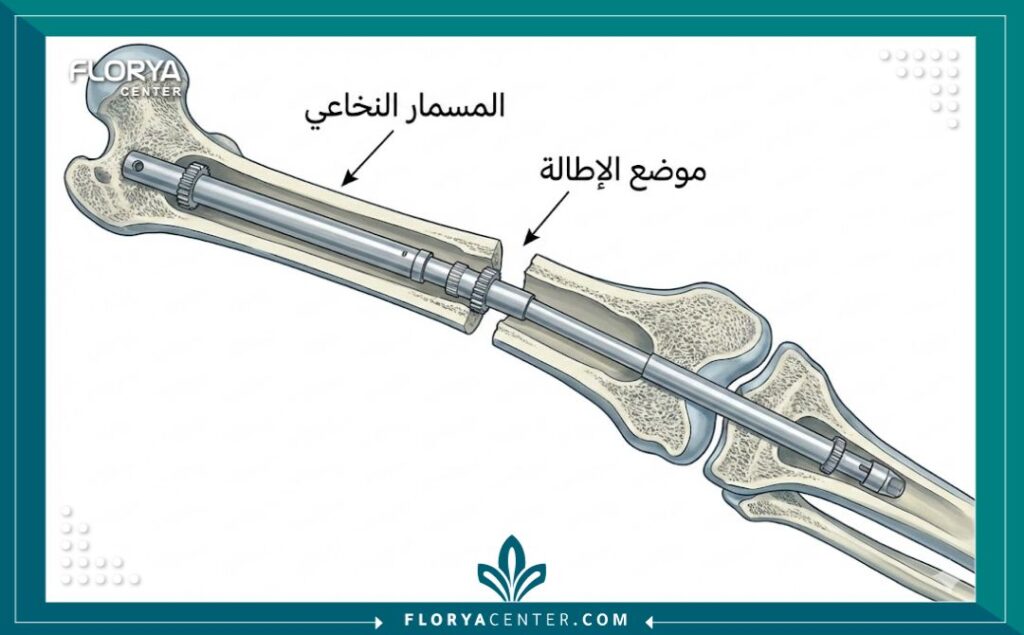 عملية تطويل العظام 1 - عملية تطويل العظام تعد عملية تطويل العظام (Limb Lengthening) إجراءً جراحياً متطوراً يهدف لزيادة طول الأطراف في Florya Center.