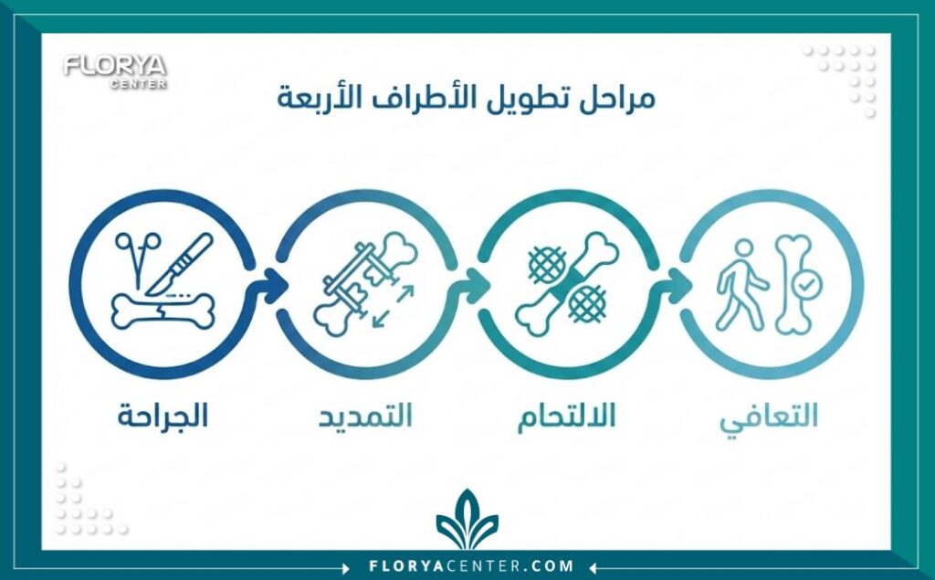 إنفوجرافيك يشرح مراحل عملية تطويل العظام من الجراحة وحتى الشفاء التام.