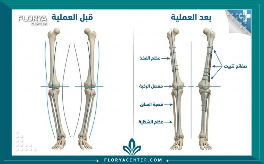 مخطط طبي يوضح الفرق بين شكل الساق قبل وبعد عملية تصحيح تقوس الساقين (Genu Varum).