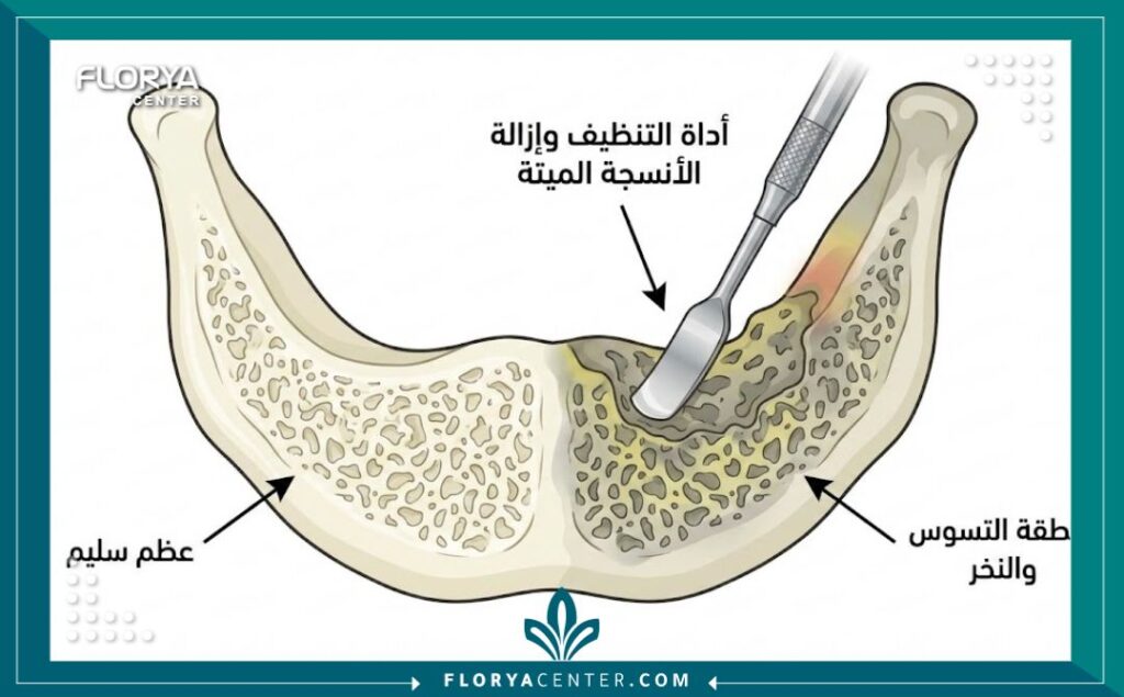 عملية تنظيف تسوس العظام 2 رسم تخطيطي طبي ومقطع عرضي يوضح الفرق بين العظم السليم ومناطق تسوس العظام (النخر) التي تتم إزالتها جراحياً.