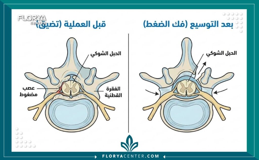 رسم توضيحي طبي يظهر الفرق بين القناة الشوكية المتضيقة والقناة الشوكية بعد عملية التوسيع الجراحي لفك الضغط عن الأعصاب.