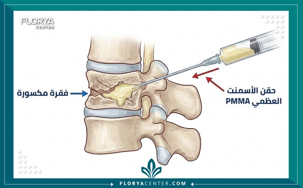 رسم تخطيطي طبي يوضح كيفية إدخال إبرة حقن الأسمنت العظمي داخل الفقرة المصابة بكسر انضغاطي.