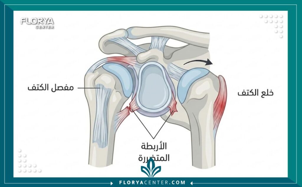 رسم تخطيطي طبي يوضح تشريح الكتف والأربطة المتضررة نتيجة الخلع المتكرر.