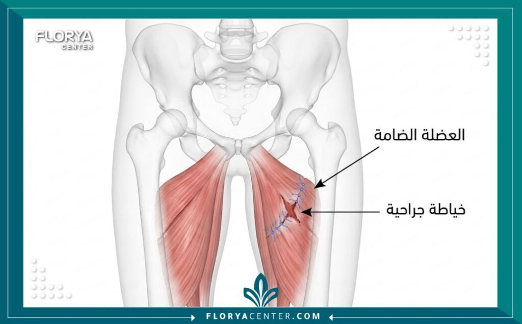 رسم تخطيطي طبي يوضح تشريح العضلة الضامة وكيفية إجراء الخياطة الجراحية للتمزق.