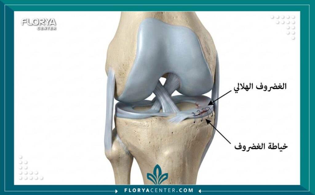 رسم توضيحي طبي يشرح كيفية إصلاح وتمزق الغضروف الهلالي في الركبة.