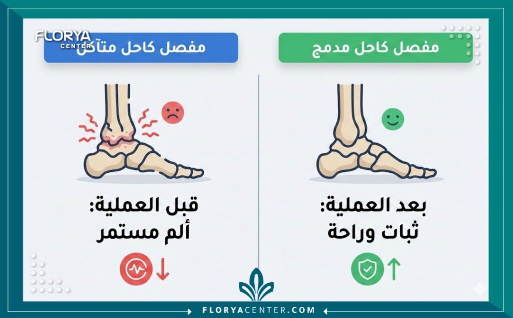 عملية دمج مفصل الكاحل 3 إنفوجرافيك يقارن بين حالة مفصل الكاحل قبل وبعد عملية دمج مفصل الكاحل وتثبيت المفصل.